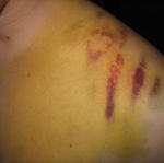 bruise as of 4/17