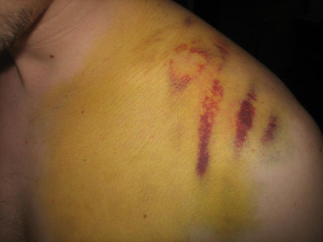 bruise as of 4/17