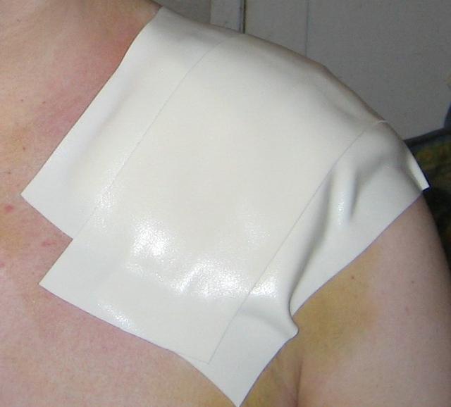 My shoulder on 4/25 (post surgery)