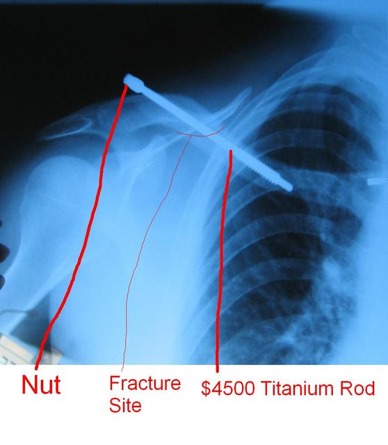 5/18/06 X-ray of Titanium Rod showing mended clavicle